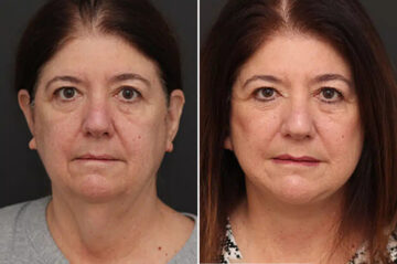 Facelift Before and After Photos in Princeton, NJ, Patient 21194