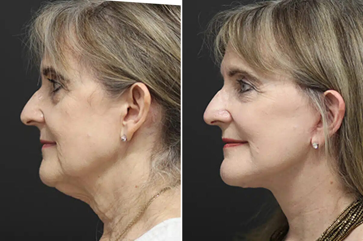 Facelift Before and After Photos in Princeton, NJ, Patient 21198