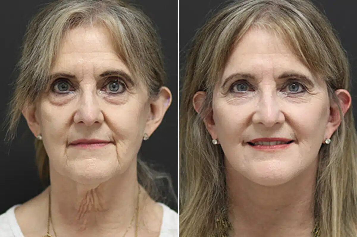 Facelift Before and After Photos in Princeton, NJ, Patient 21198