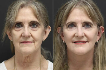 Facelift Before and After Photos in Princeton, NJ, Patient 21198