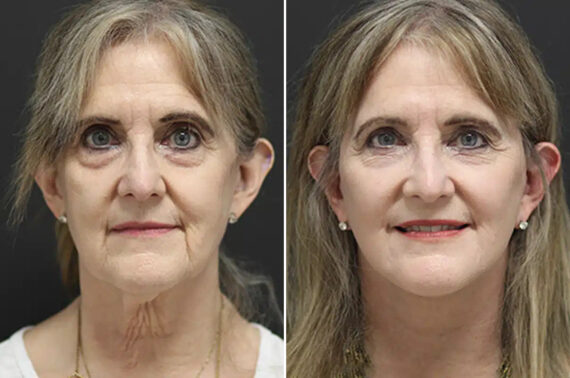 Facelift Before and After Photos in Princeton, NJ, Patient 21198