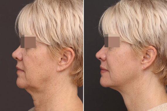 Facelift Before and After Photos in Princeton, NJ, Patient 21201