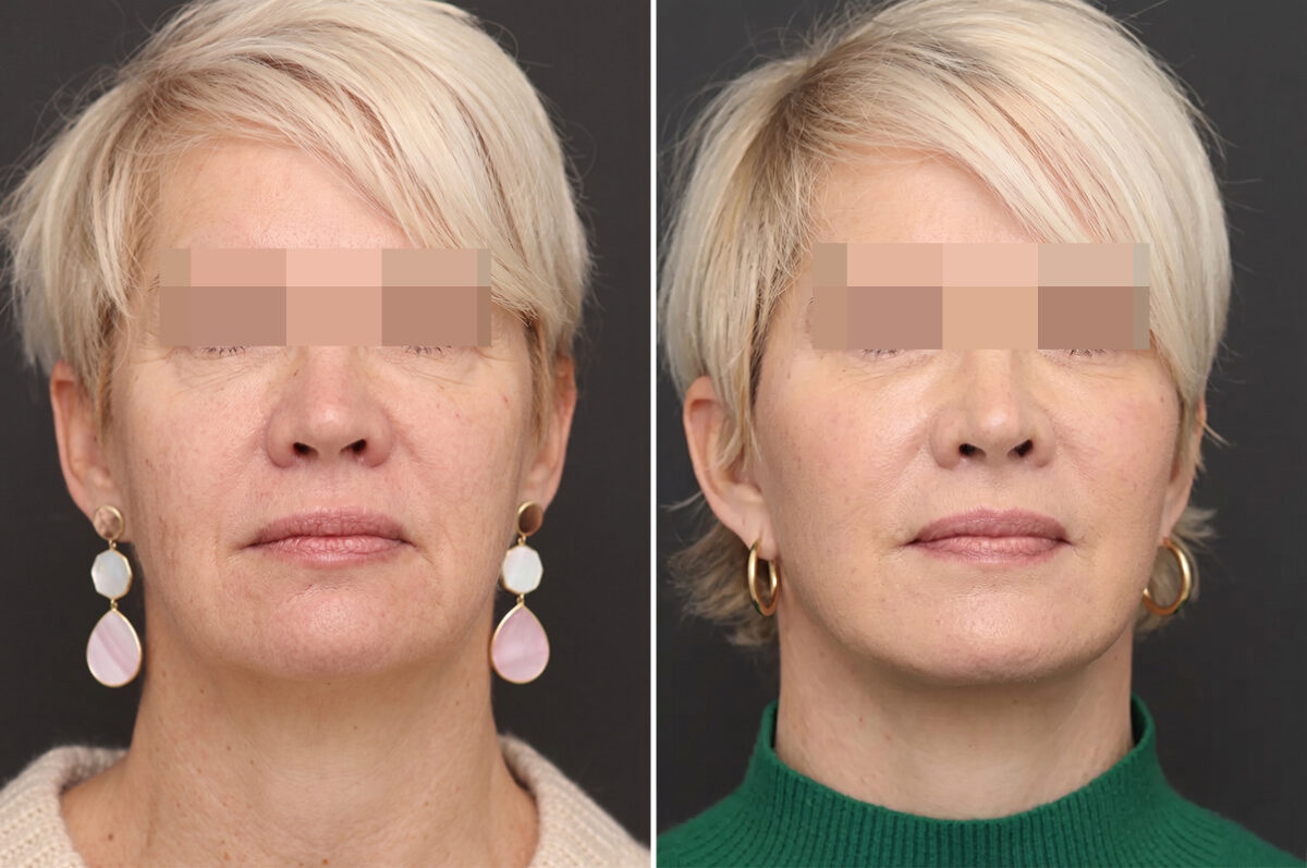 Facelift Before and After Photos in Princeton, NJ, Patient 21201
