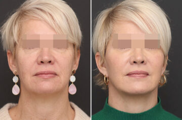 Facelift Before and After Photos in Princeton, NJ, Patient 21201