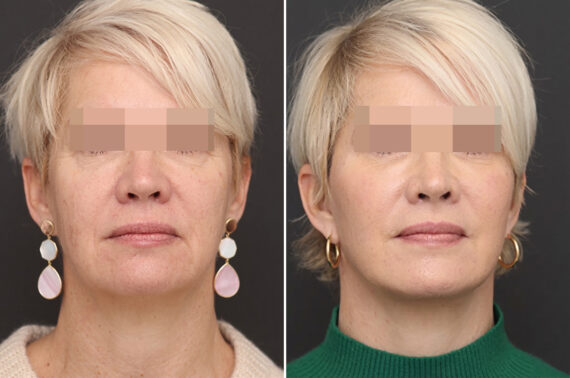 Facelift Before and After Photos in Princeton, NJ, Patient 21201