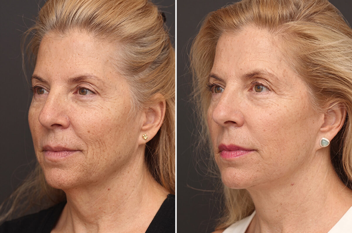Facelift Before and After Photos in Princeton, NJ, Patient 21204