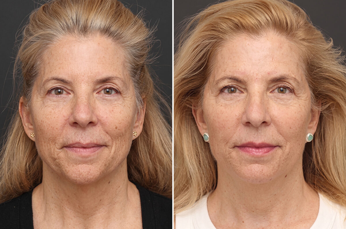 Facelift Before and After Photos in Princeton, NJ, Patient 21204