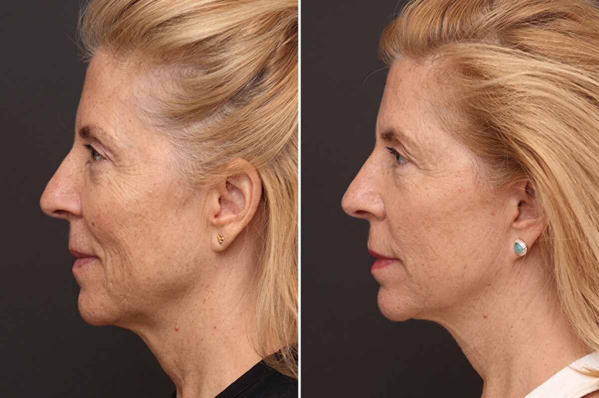 Facelift Before and After Photos in Princeton, NJ, Patient 21204