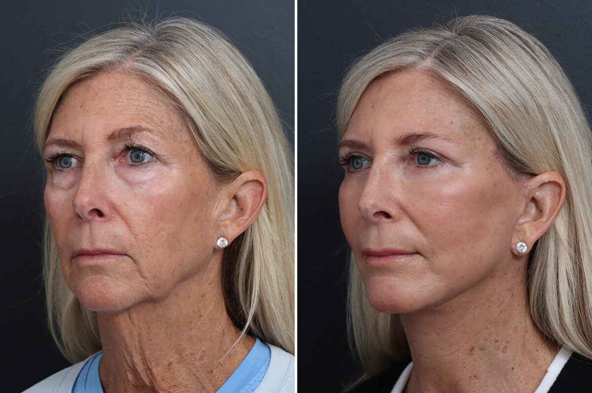 Facelift Before and After Photos in Princeton, NJ, Patient 21208