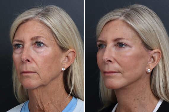 Facelift Before and After Photos in Princeton, NJ, Patient 21208