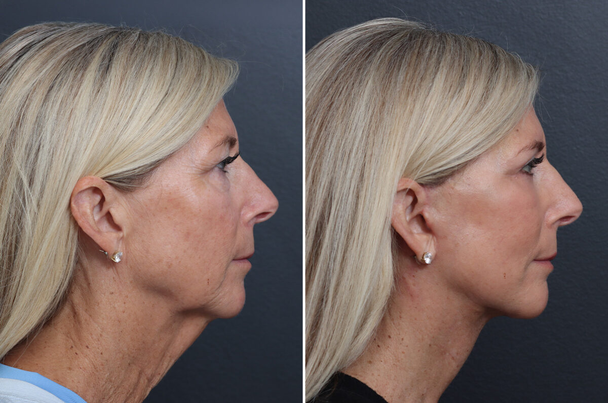 Facelift Before and After Photos in Princeton, NJ, Patient 21208