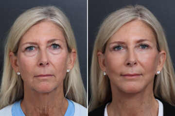 Facelift Before and After Photos in Princeton, NJ, Patient 21208