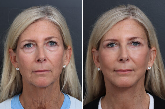 Facelift Before and After Photos in Princeton, NJ, Patient 21208