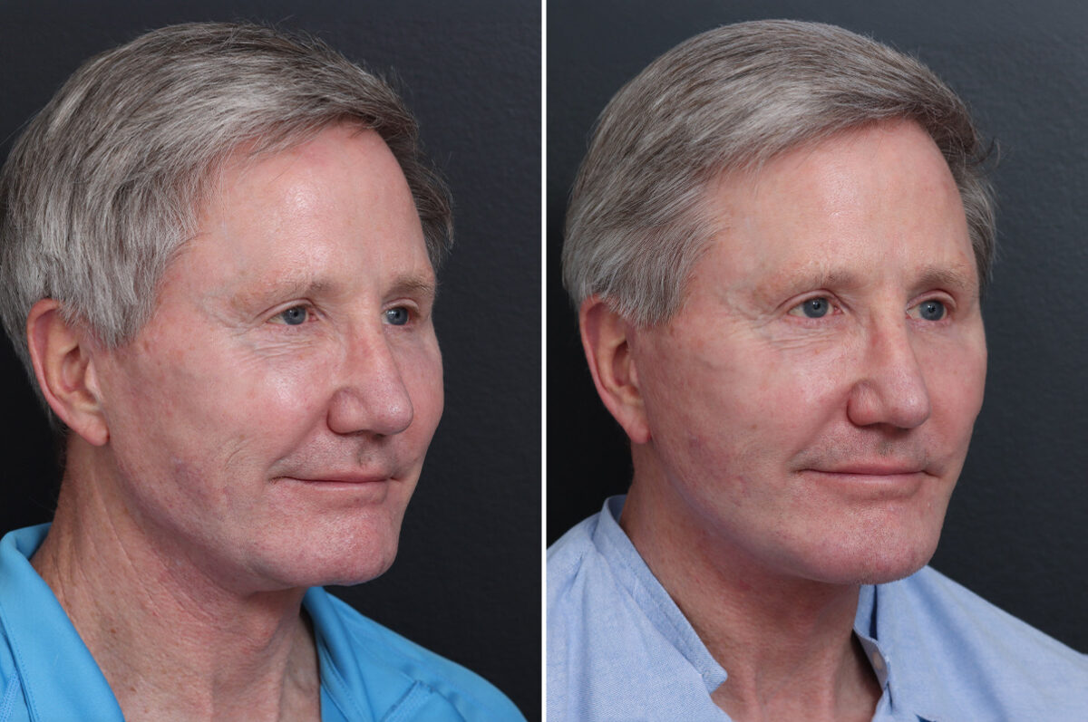 Facelift Before and After Photos in Princeton, NJ, Patient 21212