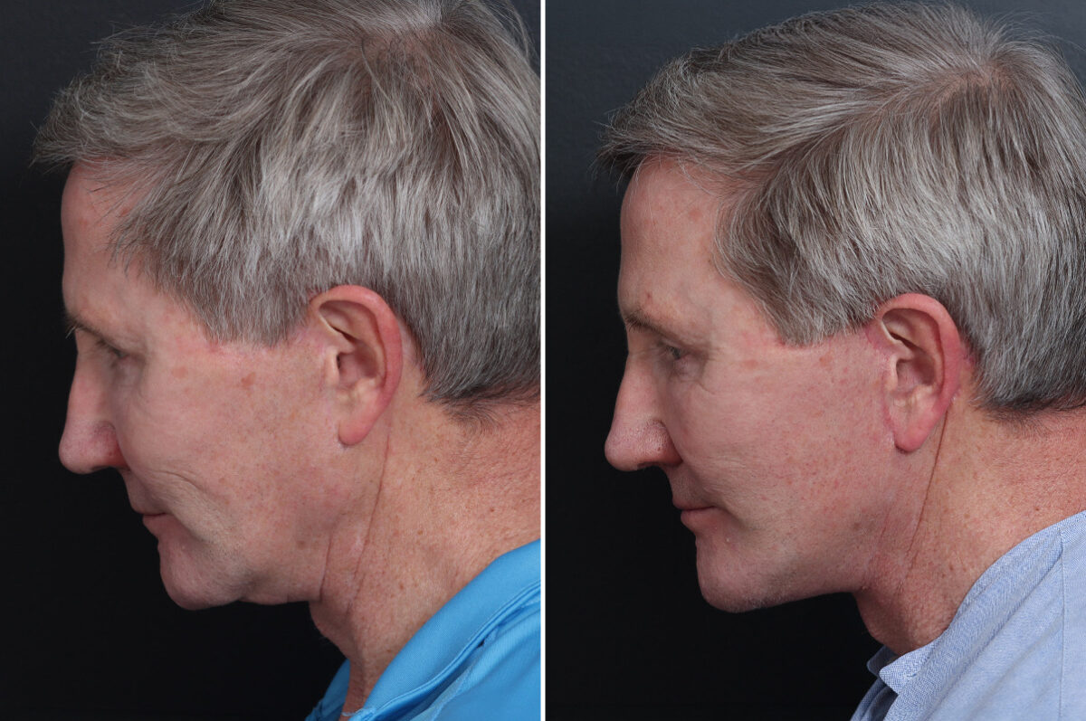 Facelift Before and After Photos in Princeton, NJ, Patient 21212