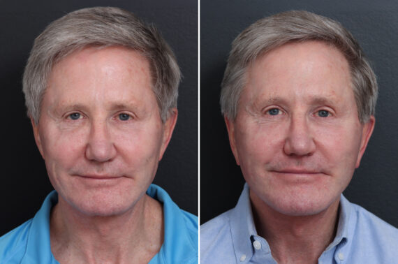 Facelift Before and After Photos in Princeton, NJ, Patient 21212