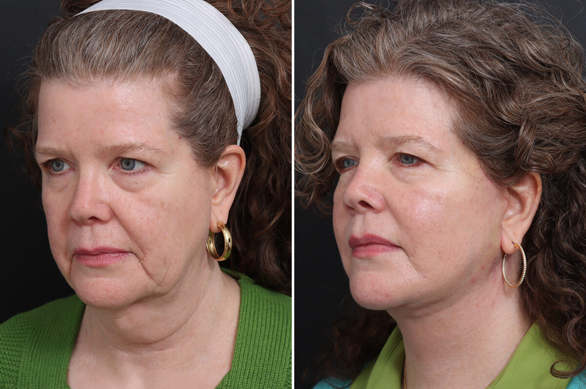 Facelift Before and After Photos in Princeton, NJ, Patient 21216