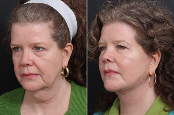 Facelift Before and After Photos in Princeton, NJ, Patient 21216