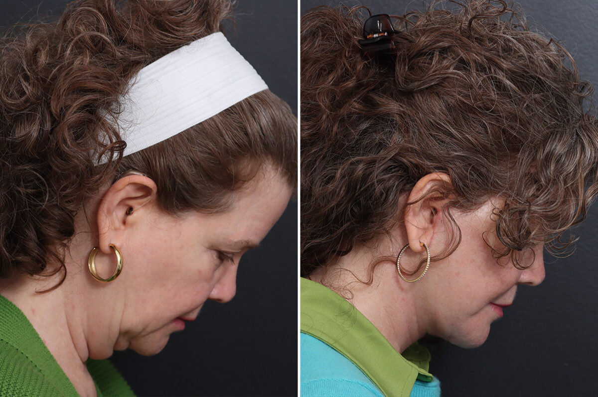 Facelift Before and After Photos in Princeton, NJ, Patient 21216
