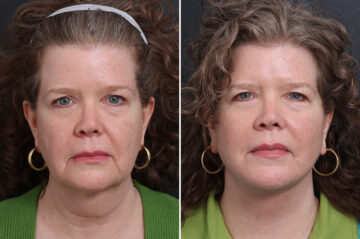 Facelift Before and After Photos in Princeton, NJ, Patient 21216