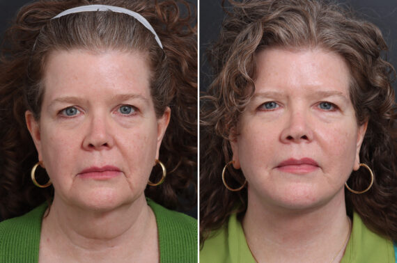Facelift Before and After Photos in Princeton, NJ, Patient 21216