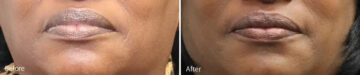 Lip Augmentation Before and After Photos in Princeton, NJ, Patient 21220