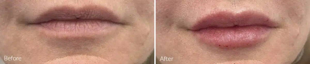 Lip Augmentation Before and After Photos in Princeton, NJ, Patient 21235