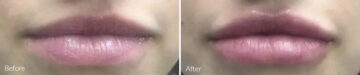Lip Augmentation Before and After Photos in Princeton, NJ, Patient 21237