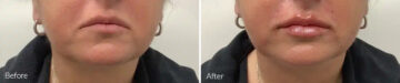 Lip Augmentation Before and After Photos in Princeton, NJ, Patient 21239
