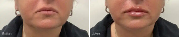 Lip Augmentation Before and After Photos in Princeton, NJ, Patient 21239