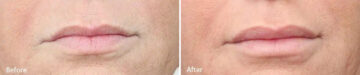 Lip Augmentation Before and After Photos in Princeton, NJ, Patient 21241