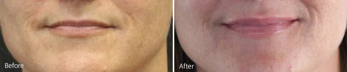 Lip Augmentation Before and After Photos in Princeton, NJ, Patient 21243