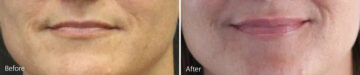 Lip Augmentation Before and After Photos in Princeton, NJ, Patient 21243