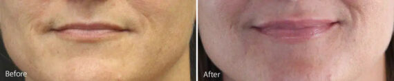 Lip Augmentation Before and After Photos in Princeton, NJ, Patient 21243