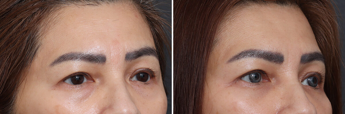 Lower Eyelid Surgery Before and After Photos in Princeton, NJ, Patient 21245