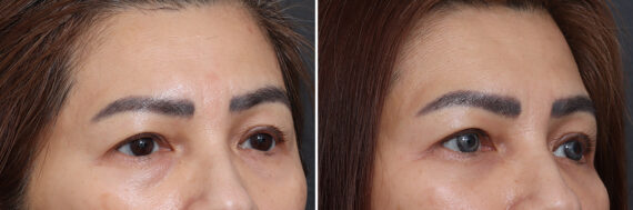 Lower Eyelid Surgery Before and After Photos in Princeton, NJ, Patient 21245