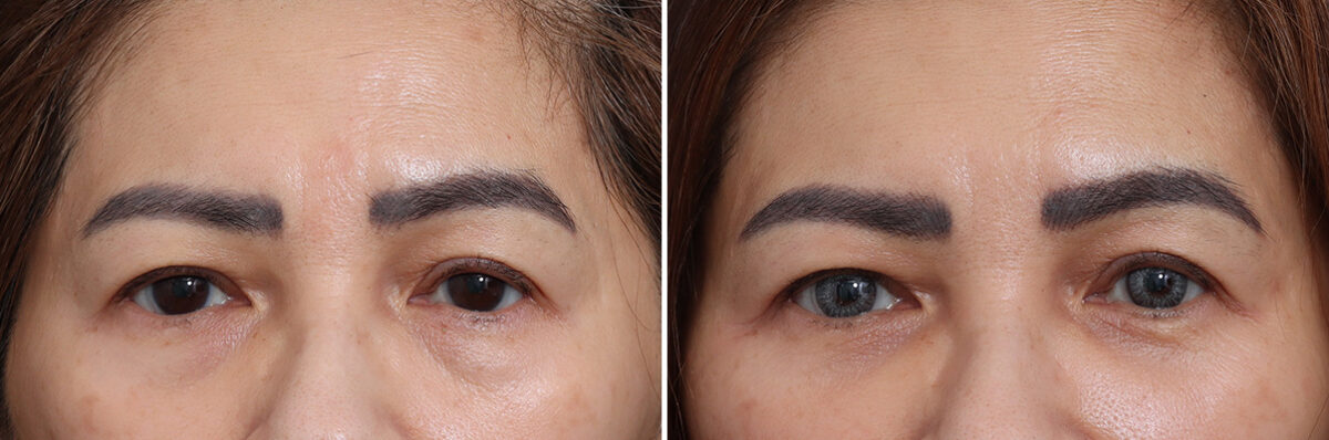 Lower Eyelid Surgery Before and After Photos in Princeton, NJ, Patient 21245