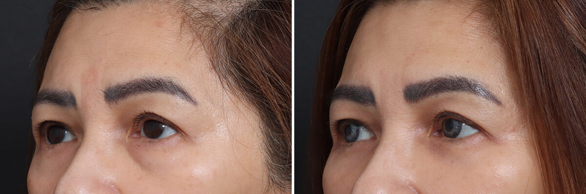 Lower Eyelid Surgery Before and After Photos in Princeton, NJ, Patient 21245