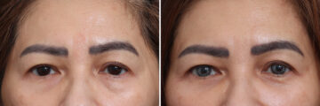 Lower Eyelid Surgery Before and After Photos in Princeton, NJ, Patient 21245