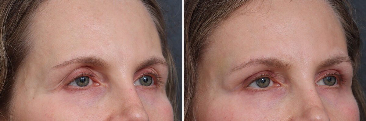 Upper Eyelid Surgery Before and After Photos in Princeton, NJ, Patient 21255