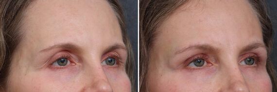 Upper Eyelid Surgery Before and After Photos in Princeton, NJ, Patient 21255