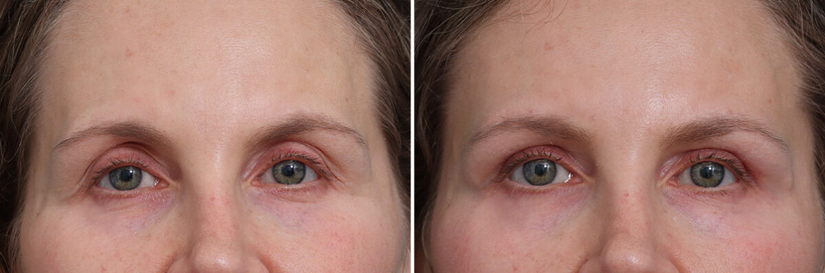 Upper Eyelid Surgery Before and After Photos in Princeton, NJ, Patient 21255