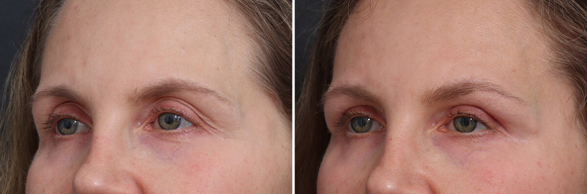 Upper Eyelid Surgery Before and After Photos in Princeton, NJ, Patient 21255