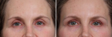 Upper Eyelid Surgery Before and After Photos in Princeton, NJ, Patient 21255