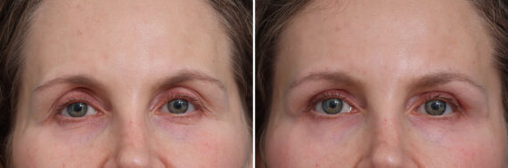 Upper Eyelid Surgery Before and After Photos in Princeton, NJ, Patient 21255