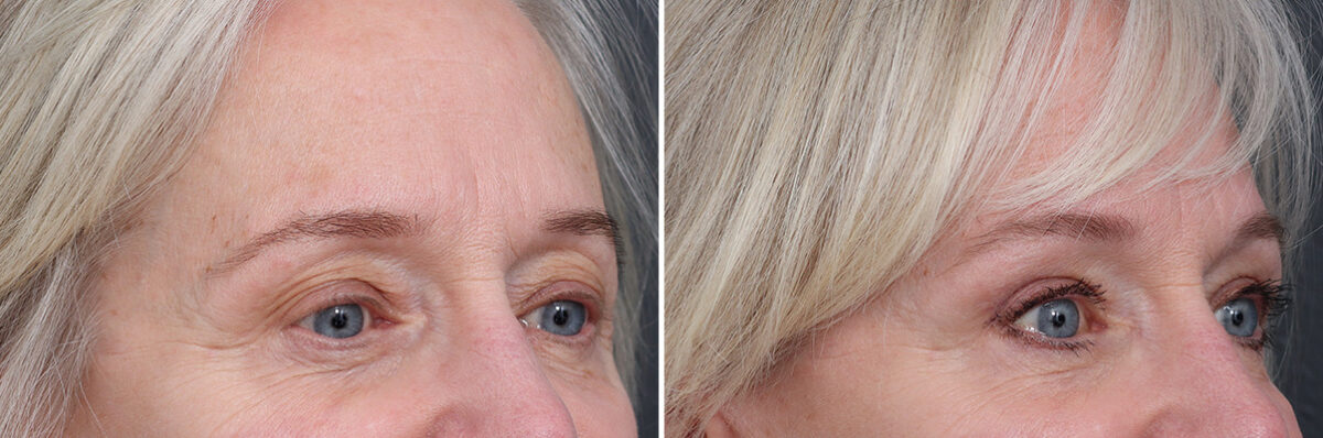 Upper Eyelid Surgery Before and After Photos in Princeton, NJ, Patient 21289