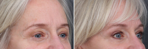 Upper Eyelid Surgery Before and After Photos in Princeton, NJ, Patient 21289