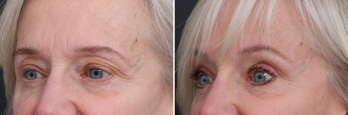 Upper Eyelid Surgery Before and After Photos in Princeton, NJ, Patient 21289