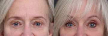 Upper Eyelid Surgery Before and After Photos in Princeton, NJ, Patient 21289