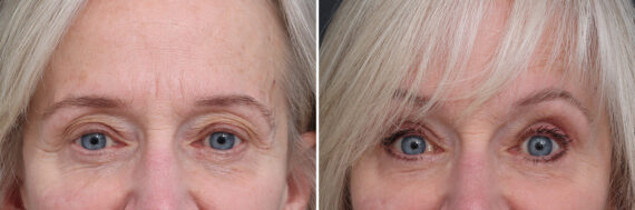 Upper Eyelid Surgery Before and After Photos in Princeton, NJ, Patient 21289